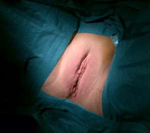 Labioplastia de reducción