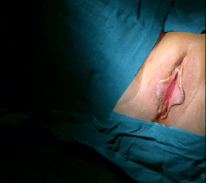 Labioplastia de reducción