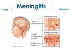 Meningitis vacunas