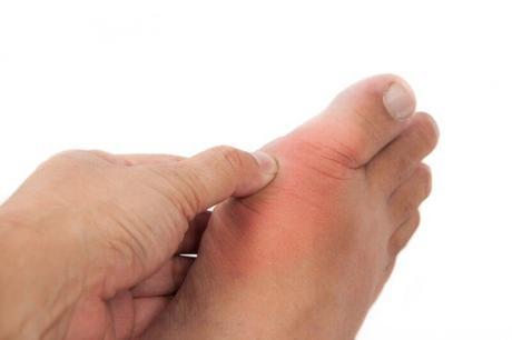 La gota: ¿Podría usted reconocer esta forma compleja de artritis?