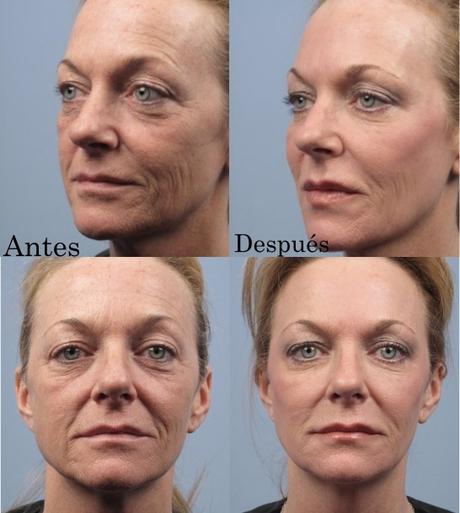 Profound La Última Revelación en Radiofrecuencia Facial de Syneron Candela