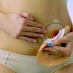 Viviendo con una bolsa colostomía: Lo que usted necesita saber