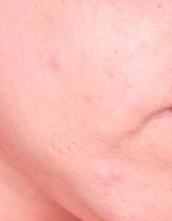 ¡¡SOS!! Un brote de acné: Así lo afronté yo.