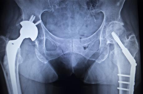 Innovador implante de cadera es desarrollado con huesos bovinos