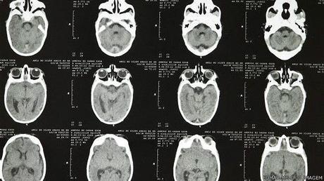 ¿Qué es la microcefalia, el mal vinculado al virus zika?