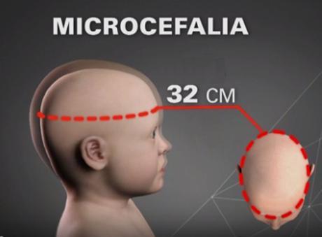 ¿Qué es la microcefalia, el mal vinculado al virus zika?