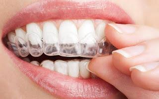 ferulas blanqueadoras