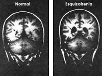 Origen Biologico de la Esquizofrenia