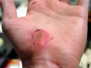 800px-Hand_Abrasion_-_2_days_22_hours_12_minutes_after_injury