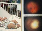 Detectar retinoblastoma bebé gracias fotografía teléfono móvil
