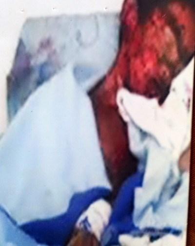 Esta foto tomada con el celular de la madre, muestra las quemaduras del niño (foto de cortesía)