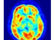 Imágenes tomografía emisión positrones envejecimiento enfermedad Alzheimer temprana.
