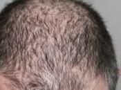 calvicie hereditaria