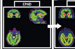 Los otros signos del Parkinson