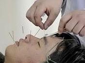 acupuntura tiene riesgos