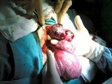 La Histerectomia predispone a Cancer Renal