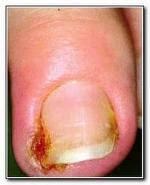 ¿ Porque se Encarnan la Uñas y como tratarlo ?