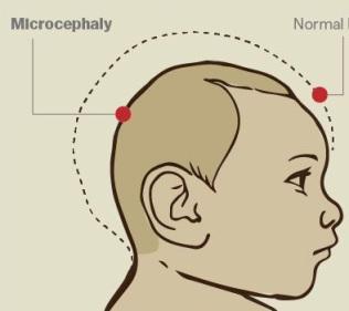 Microcefalia