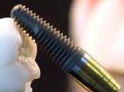 ¿Cómo saber implante dental está fallando hacer respecto?