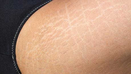 9 efectivos y milagrosos remedios caseros para las estrías
