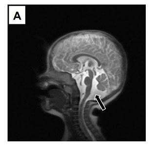 Dandy Walker-Cerebelo-miopatía- vérmix-hipoplasia-blog-blogger