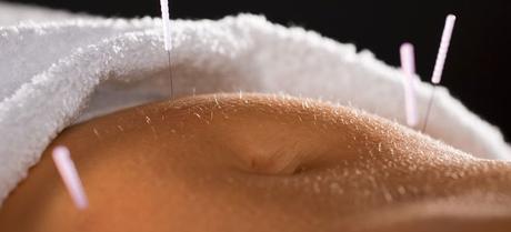 La acupuntura ¿Puede realmente ayudar con la fibromialgia? la acupuntura