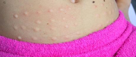 nice-body-mesoterapia-reducir-abdomen