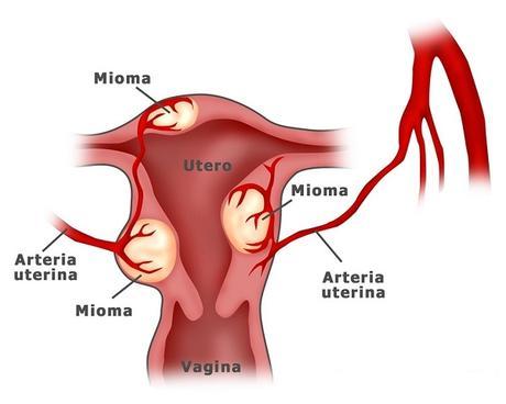 Útero miomatoso, todo sobre esta enfermedad