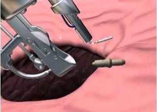 método apollo almería, método apollo granada