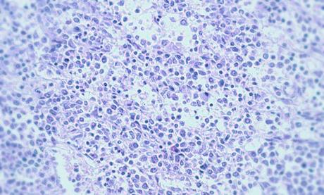 Leucemia mieloide cronica, avances en su tratamiento.