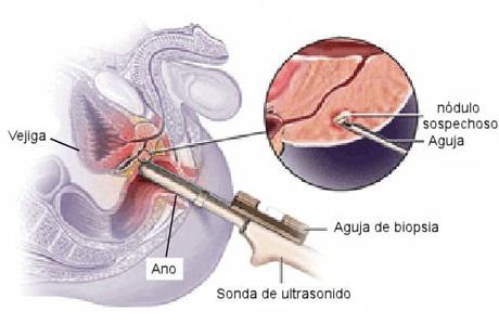 Biopsia-de-prostata