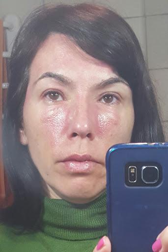 Dermatitis, más allá de lo estético (II): Tratamiento facial que me funciona
