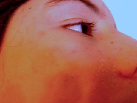 Eva Rogado: Tratamiento piel descamada con acné Eva Rogado: Tratamiento piel descamada con acné