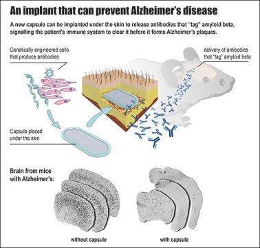 Un implante genéticamente modificado que podría prevenir el Alzheimer implante alzheimer
