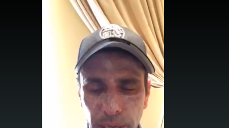 HENRIQUE CAPRILES... HABLA SOBRE SU PROBLEMA EN EL ROSTRO Capriles Radonski con lesiones en la cara | Foto: Capture Periscope