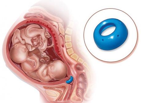 ¿Qué es un cuello uterino incompetente durante el embarazo? ¿Qué es un cuello uterino incompetente durante el embarazo?