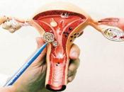 ¿Puede causar infertilidad fibromas uterinos?