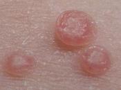 molusco contagioso (molluscum contagiosum)