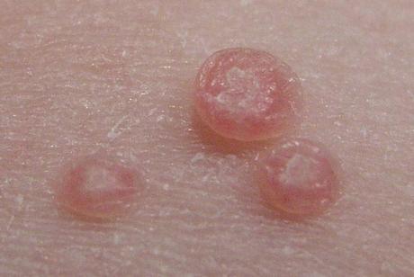 Infecciones de la piel