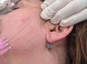 Hilos Tensores: Push-Up Facial Cirujía