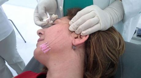 Hilos-tensores-Push-facial-cirugia_TINIMA20140109_1108_5
