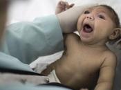 confirma relación entre virus zika microcefalia