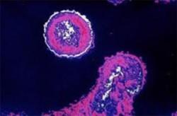 hiv 250x164 Cura del VIH con células madre   realmente?