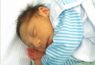 microcefalia por zika