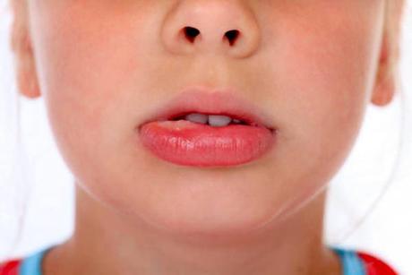 Las lesiones orales: Mucocele oral y las aftas bucales