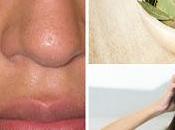 Beneficios hojas laurel para eliminar caspa acné