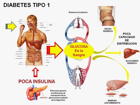 Descifran el Rompecabezas de la Diabetes tipo 1