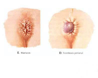 hemorroides-mariscos-y-trombosis-perianal