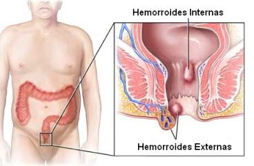 Hemorroides-Internas-y-Externas