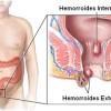 3 remedios naturales para las hemorroides